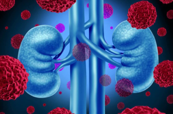 New Treatment Zanzalintinib For Advanced Kidney Cancer Action New Treatment Zanzalintinib For Advanced Kidney Cancer Action