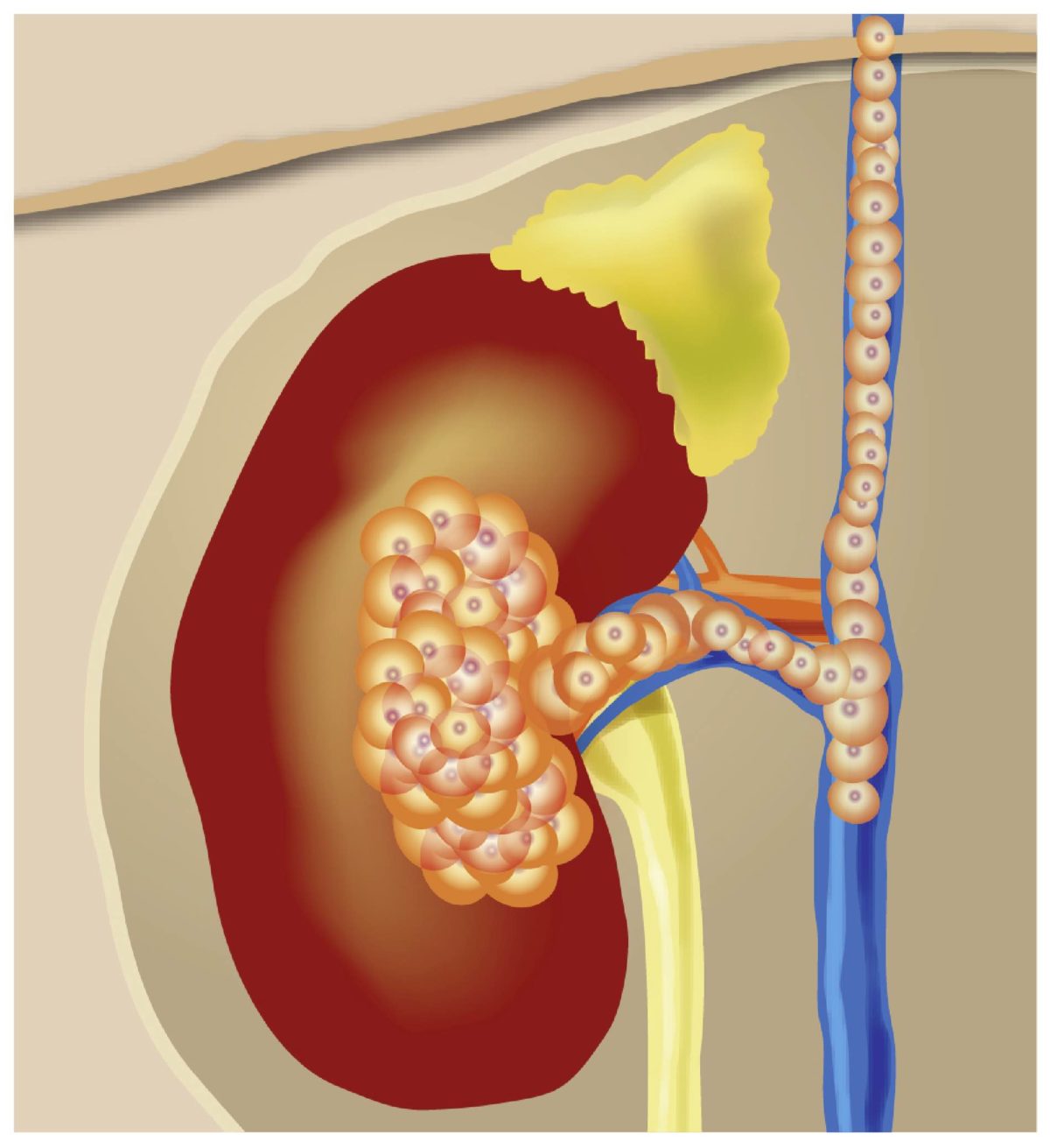 New Research Sheds Light On How Kidney Cancer Spreads Action Kidney New Research Sheds Light On How Kidney Cancer Spreads Action Kidney